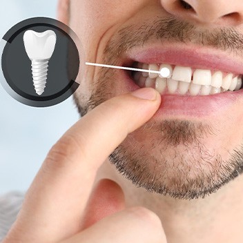 Nose-to-neck closeup of man pointing to a tooth indicated as an implant