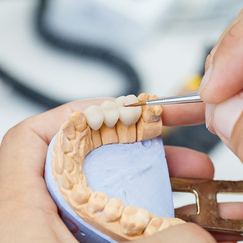 A dentist working on a dental bridge