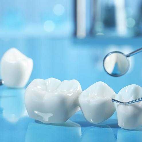 A dental bridge and implant parts set against a blue background