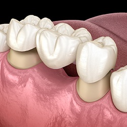 A 3D illustration of a dental bridge