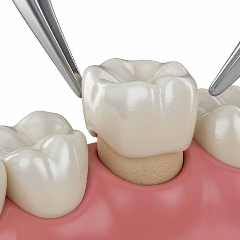A CGI of a dental crown fitted onto a tooth