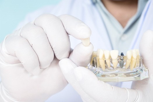 Dentist in white gloves holding sample dental implant and crown