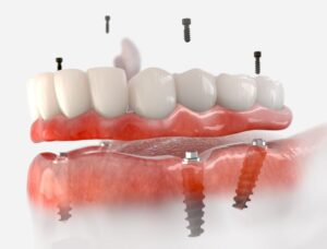 Illustration showing All-on-X denture 